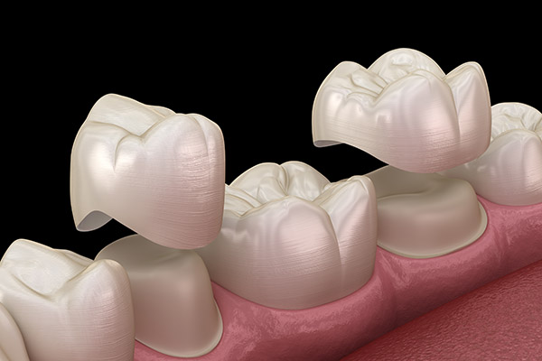 Crown Lengthening Procedure From A Periodontist