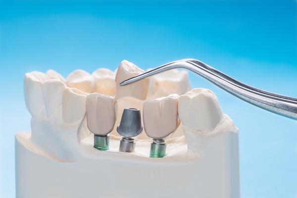 Benefits To Replace Missing Teeth With Dental Implants