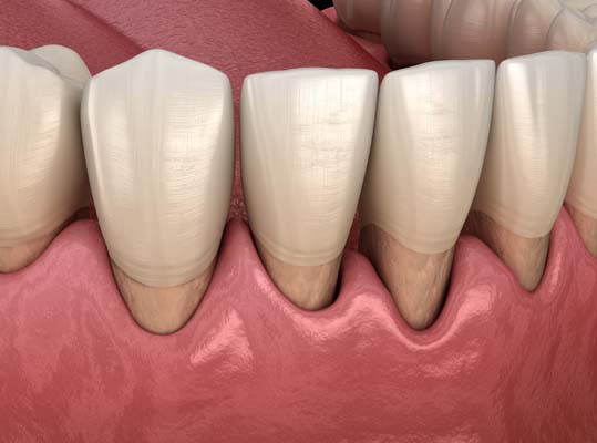 Peridontist Treatment For Gum Recession