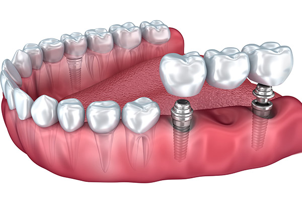 Implant Dentistry Options With Dental Bridges