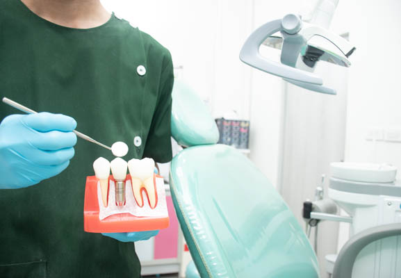An Implant Periodontist Shares The Steps Of Replacing Missing Teeth With Dental Implants
