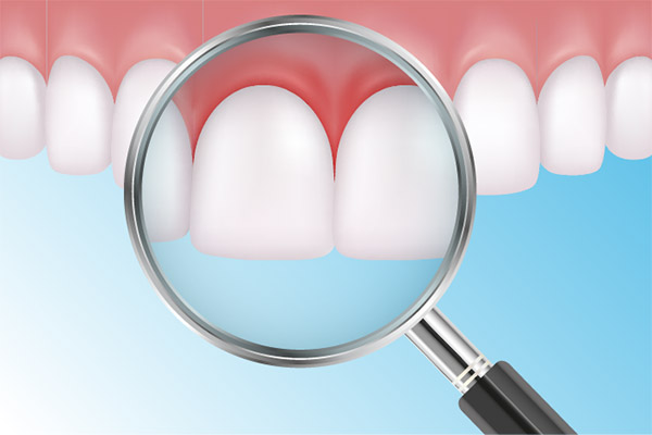 How a Periodontist Uses Scaling and Root Planing to Treat Gum Disease from Brighton Periodontal & Implant Dental Group in Woodland Hills, CA
