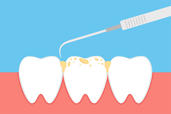 What Your Periodontist Wants You to Know About Plaque and Tartar from Brighton Periodontal & Implant Dental Group in Woodland Hills, CA