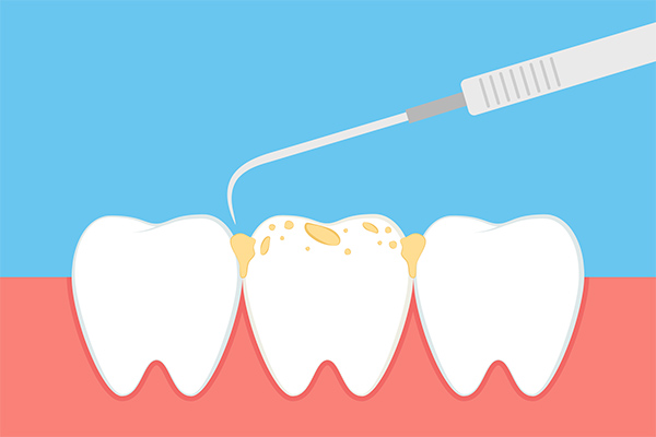 What Your Periodontist Wants You to Know About Plaque and Tartar